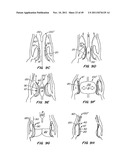 REPLACEMENT VALVE AND ANCHOR diagram and image