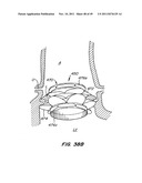 REPLACEMENT VALVE AND ANCHOR diagram and image