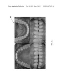 Computer-aided Fabrication Of A Removable Dental Prosthesis diagram and image