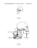 Computer-aided Fabrication Of A Removable Dental Prosthesis diagram and image