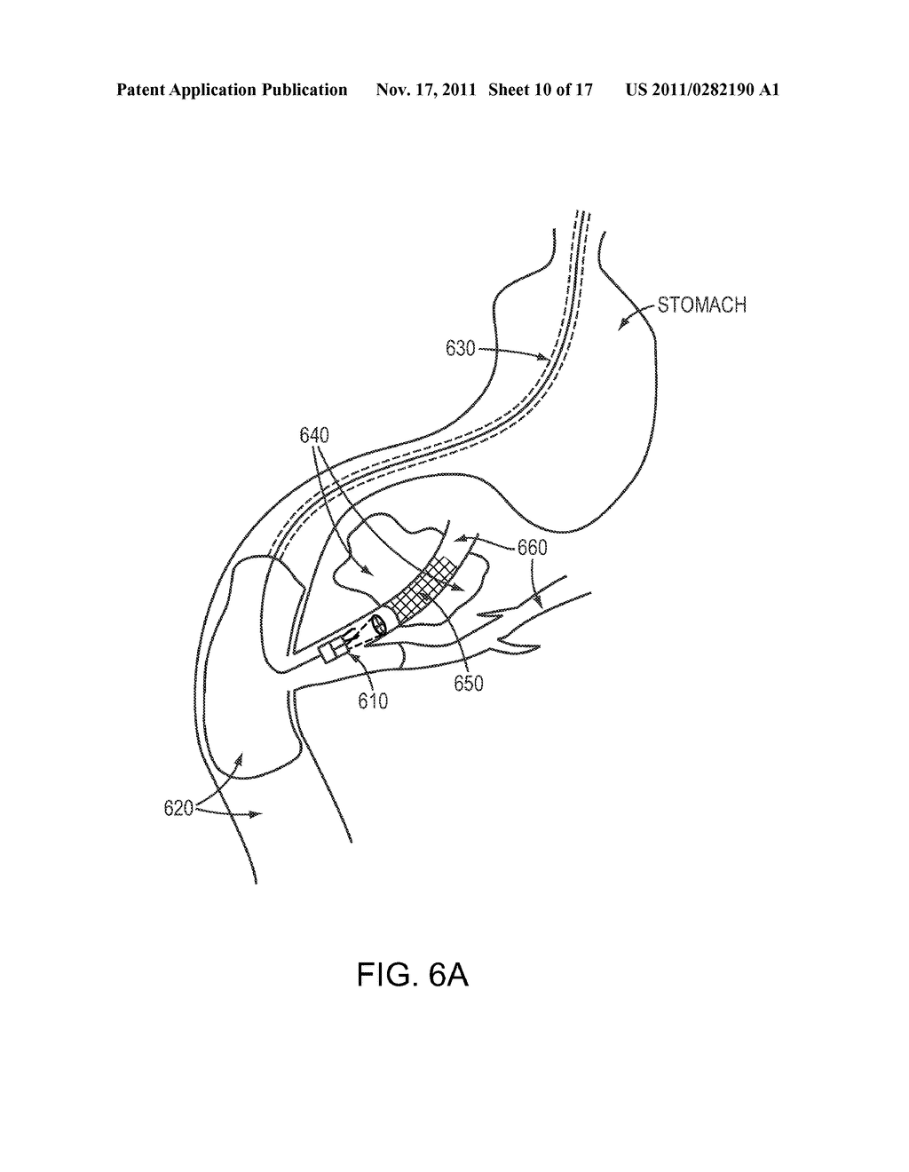 COMBINED ENDOSCOPIC SURGICAL TOOLS - diagram, schematic, and image 11