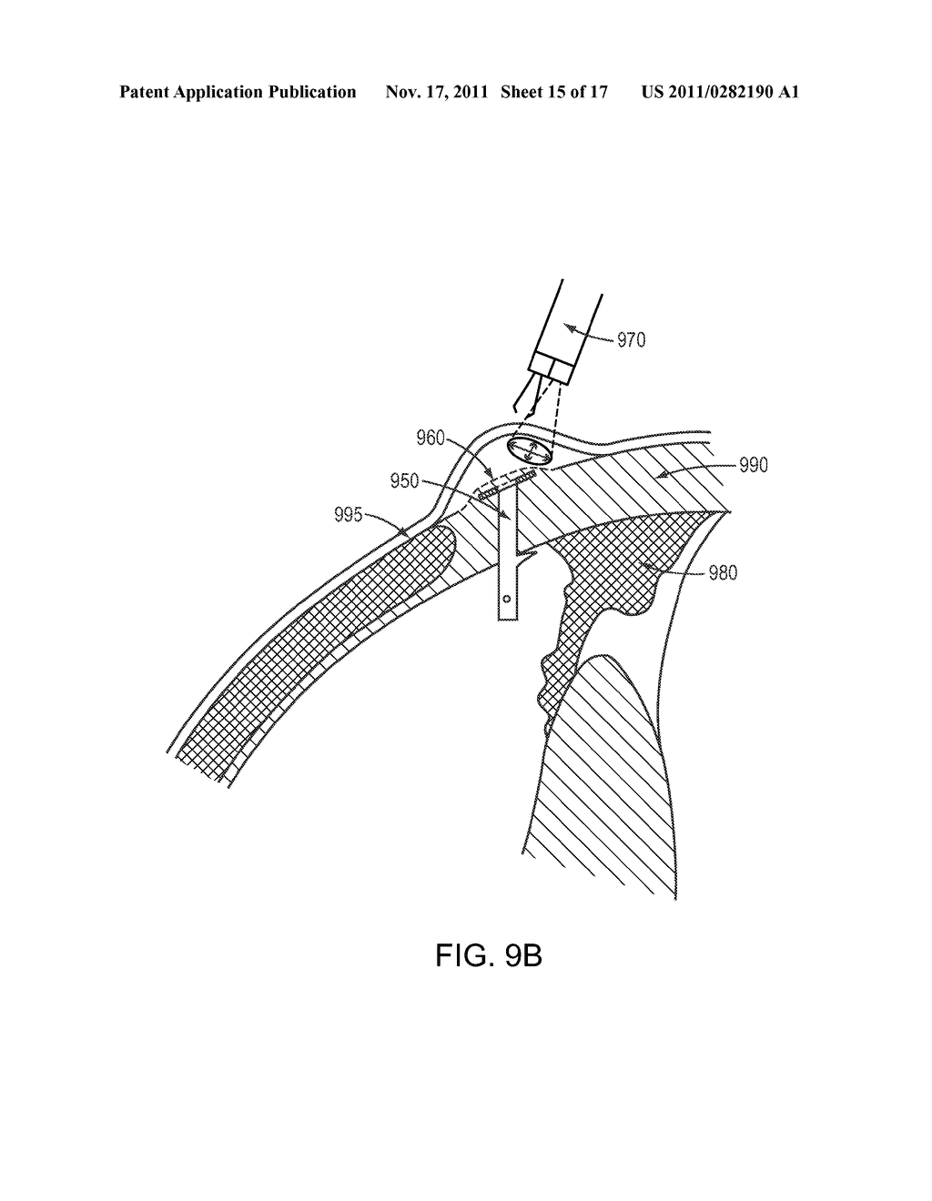 COMBINED ENDOSCOPIC SURGICAL TOOLS - diagram, schematic, and image 16