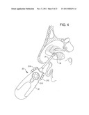 Methods and Systems for Delivery of Acoustic Energy to Tissue Surfaces,     Cavities and Obstructed Passages such as Intranasal Ostia diagram and image