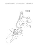 Methods and Systems for Delivery of Acoustic Energy to Tissue Surfaces,     Cavities and Obstructed Passages such as Intranasal Ostia diagram and image