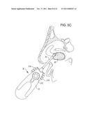 Methods and Systems for Delivery of Acoustic Energy to Tissue Surfaces,     Cavities and Obstructed Passages such as Intranasal Ostia diagram and image