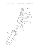 Methods and Systems for Delivery of Acoustic Energy to Tissue Surfaces,     Cavities and Obstructed Passages such as Intranasal Ostia diagram and image