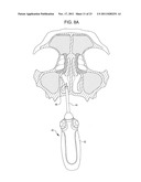 Methods and Systems for Delivery of Acoustic Energy to Tissue Surfaces,     Cavities and Obstructed Passages such as Intranasal Ostia diagram and image