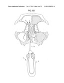 Methods and Systems for Delivery of Acoustic Energy to Tissue Surfaces,     Cavities and Obstructed Passages such as Intranasal Ostia diagram and image