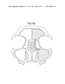 Methods and Systems for Delivery of Acoustic Energy to Tissue Surfaces,     Cavities and Obstructed Passages such as Intranasal Ostia diagram and image