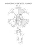 Methods and Systems for Delivery of Acoustic Energy to Tissue Surfaces,     Cavities and Obstructed Passages such as Intranasal Ostia diagram and image