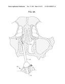 Methods and Systems for Delivery of Acoustic Energy to Tissue Surfaces,     Cavities and Obstructed Passages such as Intranasal Ostia diagram and image