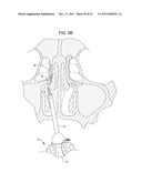 Methods and Systems for Delivery of Acoustic Energy to Tissue Surfaces,     Cavities and Obstructed Passages such as Intranasal Ostia diagram and image