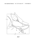 Subdural Drainage Catheter with Flow Restoration Mechanism diagram and image