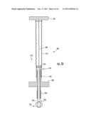 Subdural Drainage Catheter with Flow Restoration Mechanism diagram and image