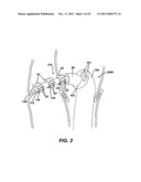 Instrument for Debriding Fistula and Applying Therapeutic Cells diagram and image