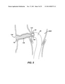 Instrument for Debriding Fistula and Applying Therapeutic Cells diagram and image