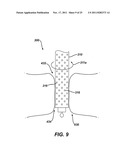 Instrument for Debriding Fistula and Applying Therapeutic Cells diagram and image