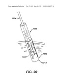 Instrument for Debriding Fistula and Applying Therapeutic Cells diagram and image