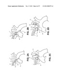 Intravascular Blood Filters and Methods of Use diagram and image