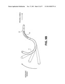 Intravascular Blood Filters and Methods of Use diagram and image