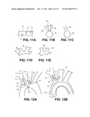 Intravascular Blood Filters and Methods of Use diagram and image