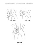 Intravascular Blood Filters and Methods of Use diagram and image