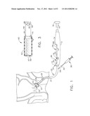 Therapeutic Cell Applicator Instrument with Modular Tips diagram and image