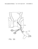 Therapeutic Cell Applicator Instrument with Modular Tips diagram and image