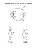 Accommodating Intraocular Lenses diagram and image