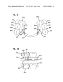 DENTAL APPLIANCE FOR CONSTRAINING THE TONGUE diagram and image