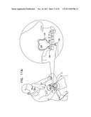 IMPLANTS, TOOLS, AND METHODS FOR SINUS LIFT AND LATERAL RIDGE AUGMENTATION diagram and image