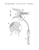 IMPLANTS, TOOLS, AND METHODS FOR SINUS LIFT AND LATERAL RIDGE AUGMENTATION diagram and image