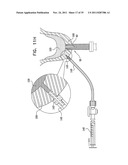 IMPLANTS, TOOLS, AND METHODS FOR SINUS LIFT AND LATERAL RIDGE AUGMENTATION diagram and image