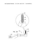 IMPLANTS, TOOLS, AND METHODS FOR SINUS LIFT AND LATERAL RIDGE AUGMENTATION diagram and image