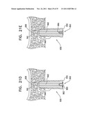 IMPLANTS, TOOLS, AND METHODS FOR SINUS LIFT AND LATERAL RIDGE AUGMENTATION diagram and image