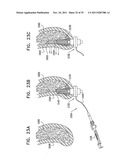 IMPLANTS, TOOLS, AND METHODS FOR SINUS LIFT AND LATERAL RIDGE AUGMENTATION diagram and image