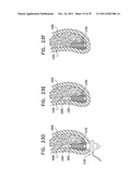 IMPLANTS, TOOLS, AND METHODS FOR SINUS LIFT AND LATERAL RIDGE AUGMENTATION diagram and image