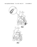 Surgical Approach to Treat Coronary Artery Syndromes diagram and image