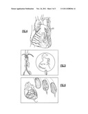 Surgical Approach to Treat Coronary Artery Syndromes diagram and image