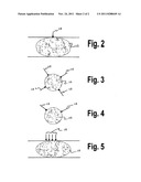 Method of lysing a thrombus diagram and image