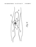 DIALYSIS VALVE AND METHOD diagram and image