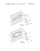 DEVICE AND METHOD FOR DISTRACTION OF THE SPINAL DISC SPACE diagram and image