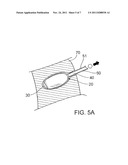 DEVICE AND METHOD FOR DISTRACTION OF THE SPINAL DISC SPACE diagram and image