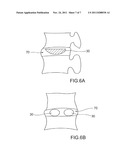 DEVICE AND METHOD FOR DISTRACTION OF THE SPINAL DISC SPACE diagram and image