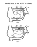 MEDICAL DEVICE FOR TISSUE ABLATION diagram and image