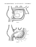 MEDICAL DEVICE FOR TISSUE ABLATION diagram and image