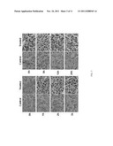 Method and Device for Ablation of Cancer and Resistance to New Cancer     Growth diagram and image