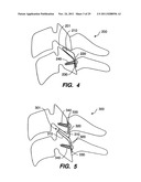 Apparatus for Sizing a Facet Joint diagram and image