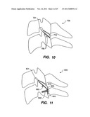 Apparatus for Sizing a Facet Joint diagram and image