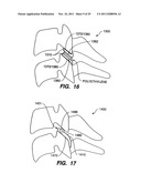 Apparatus for Sizing a Facet Joint diagram and image